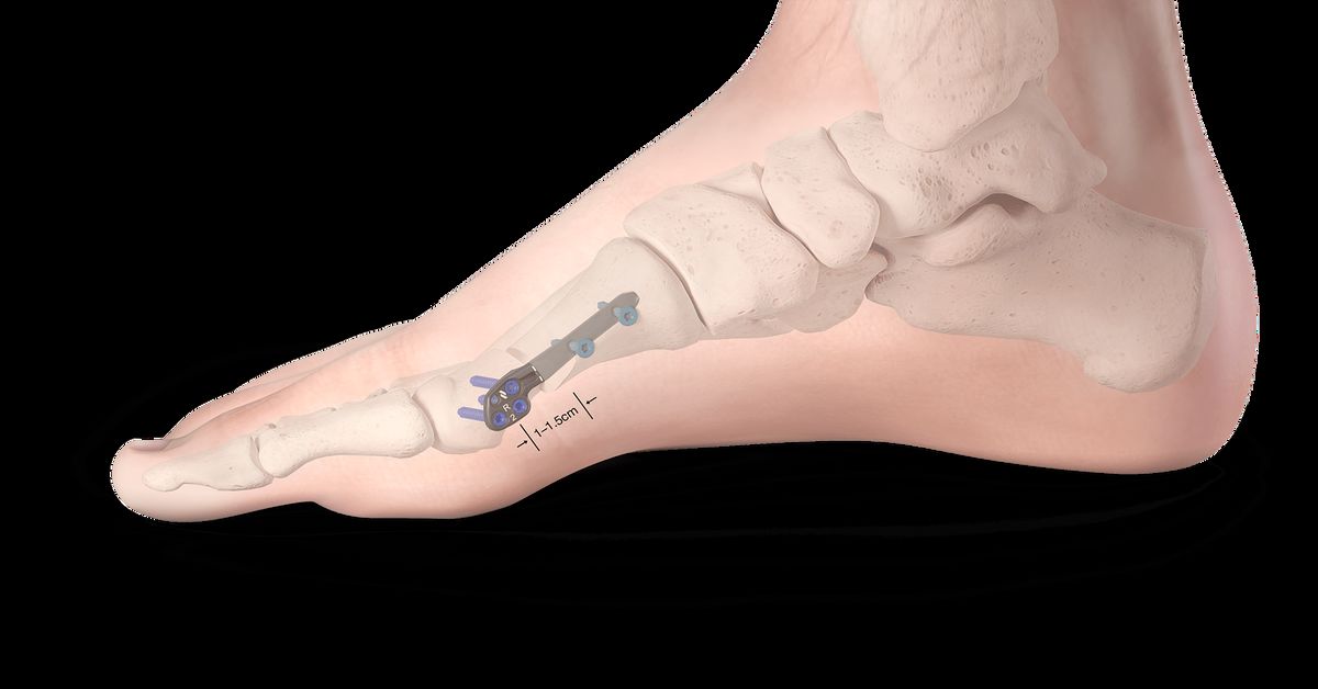 Halluks Rijidus Nedir? Halluks Rijidus Nedir?